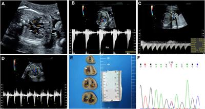 Case Report: Biventricular Noncompaction Cardiomyopathy With Pulmonary Stenosis and Bradycardia in a Fetus With KCNH2 Mutation